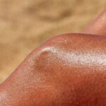 Why Does Skin Peel After Sunburn