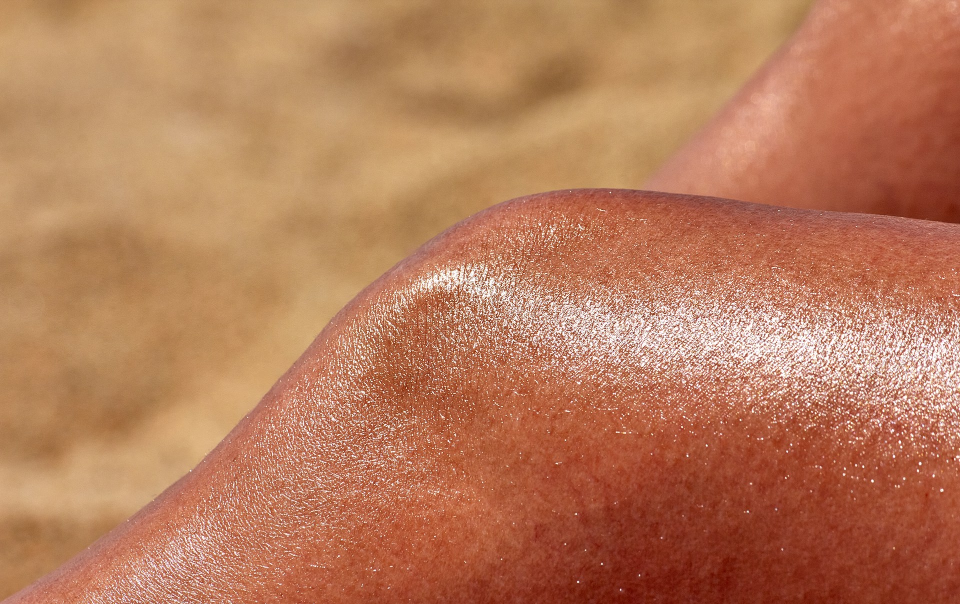 Close-up of sunburned legs with peeling skin after sun exposure.