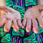 Why Do Hands Swell in Heat