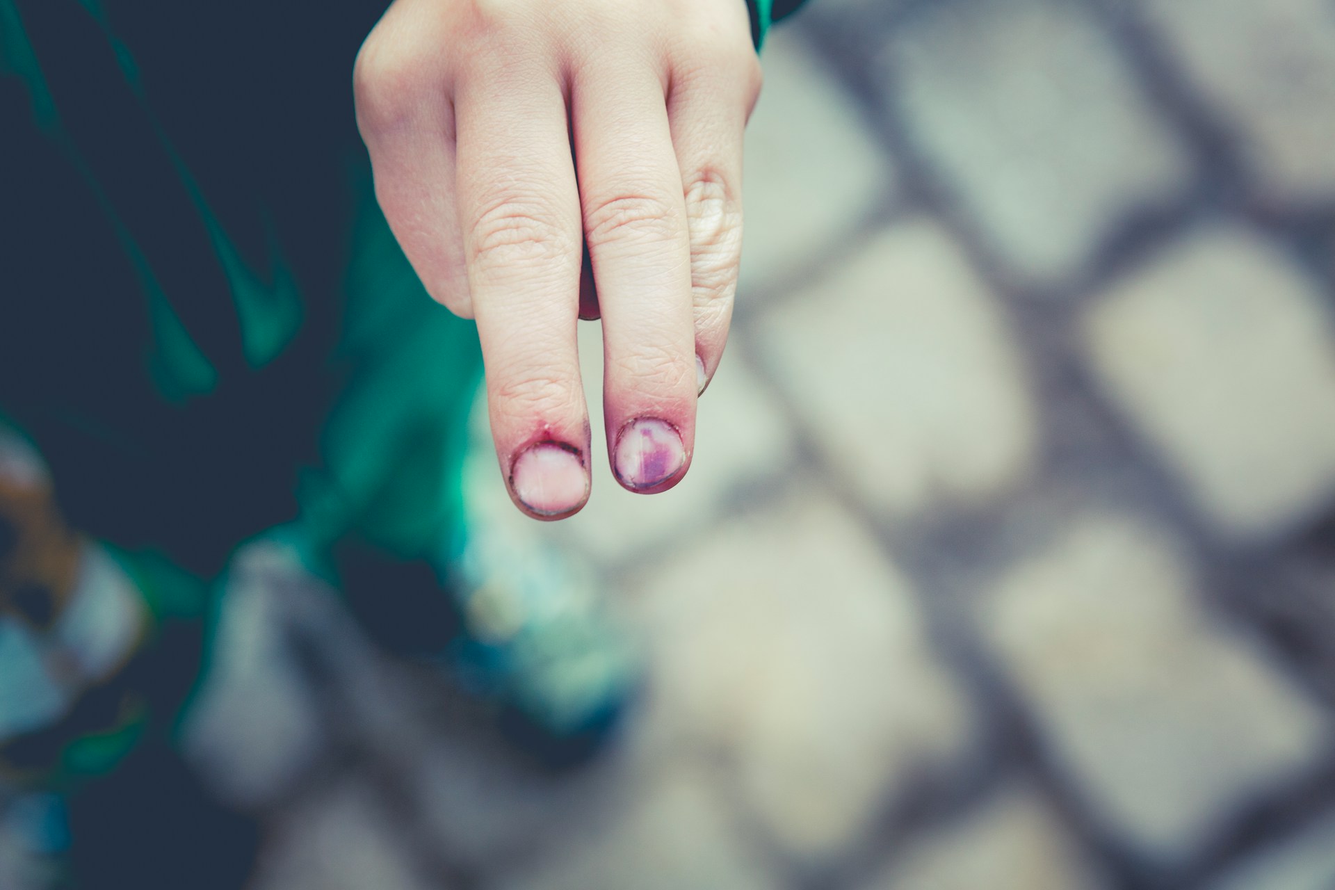 Bruise on two fingers during the healing process.